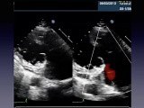 Why is My Patient in CHF？Challenging Echo Cases with Tips and Tricks • Video • MEDtube.net