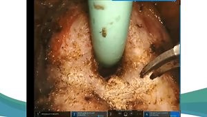 RALP: Bladder Neck Dissection