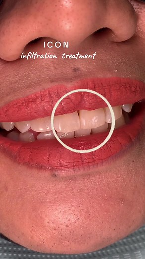 Fluorosis Treatment with ICON Resin Infiltration