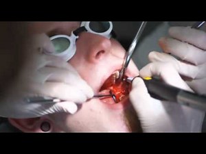 SIROLaser Advance - klinische Anwendung: Operkulektomie