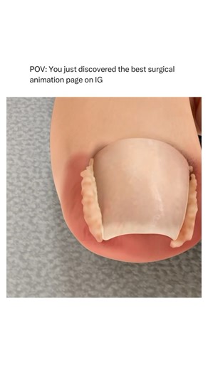 Animations on Instagram: "Follow @surgicalanimation for more! 🏥"