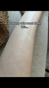 If you have strawberry legs or rough, bumpy skin—and you've tried exfoliating scrubs, loofahs, and "better" razors without results—dermatologists say you're actually using the three things that make it worse. 💔 Here's what dermatologists recommend instead for smoother, clearer skin! Bare Basics No-Shave Hair Removal Cream dissolves hair at the root without cutting or scraping (no trauma = bumps can heal). ✨ ✨ Dermatologist-recommended for keratosis pilaris and strawberry legs 🔥 50% OFF risk-fr