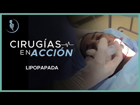 Lipopapada - Cirugía Plástica Martinez