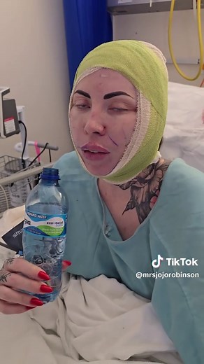 Experiencing a Facelift with Twilight Anesthesia