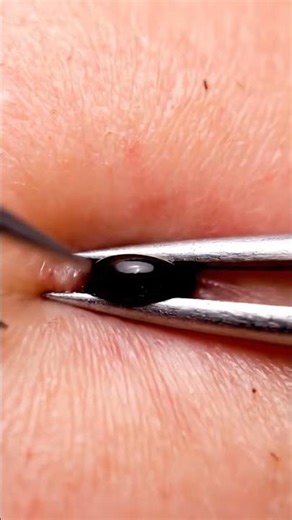 Crazy Close Up Blackhead Pops | Insane ASMR Satisfaction