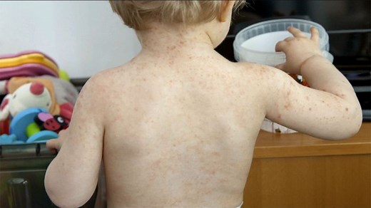 A Parent's Guide to Coxsackievirus Infection in Kids