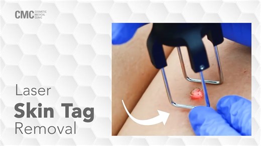 Laser Skin Tag Removal | Cosmetic Medical Clinic (CMC NSW)