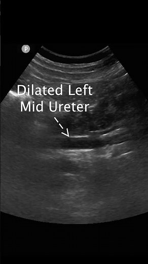 Left UVJ Stone #emergencymedicine #urology #POCUS #ultrasound