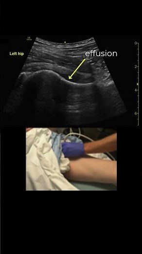 Hip Effusion, Diagnosis and Arthrocentesis #POCUS #emergencymedicine #orthopaedics