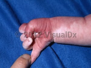 VisualDx - Sturge-Weber syndrome