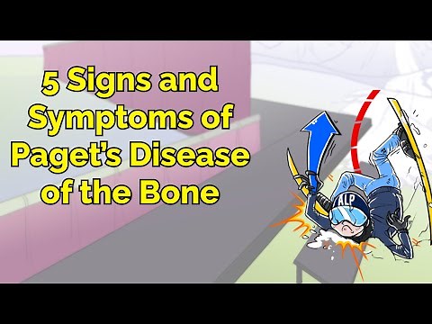 5 Signs and Symptoms of Paget’s Disease of the Bone (Step 1, COMLEX, NCLEX®, PANCE, AANP)