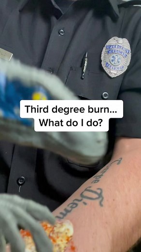 Surviving a Third Degree Burn: First Aid Tips from Jurassic Park Scene