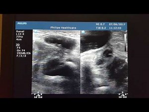 Infant Inguinal Hernia Contains Ovary ! Ultrasound