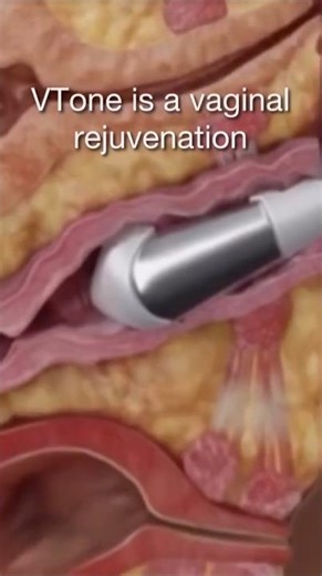 Does VTone improve vaginal health and intimacy? #femininecare #holistichealth #empowerher