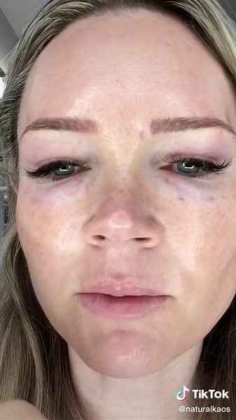 Mesotherapy Under Eyes Before and After: Eye Skincare Transformation