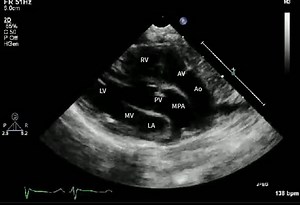 大动脉转位 Transposition of the Great Arteries (D-TGA)
