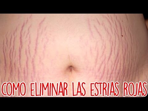 Como Eliminar Las Estrias Rojas