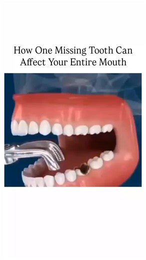 humandecod | 🦷 When a tooth is removed, it doesn’t just leave a gap — it can change everything around it. The nearby teeth may start shifting, your... | Instagram