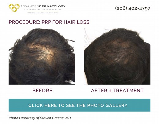 Hair Restoration with PRP in Seattle, Bellevue | Dr. Greene