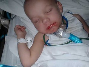 Rhabdomysarcoma, A Childhood Cancer