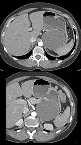 The answer to today's case | CTisus: Cutting edge information on body CT (Computed tomography).