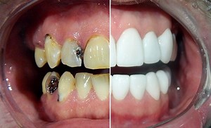 Full Mouth Reconstruction in Mexico - Cancun Dental Specialists