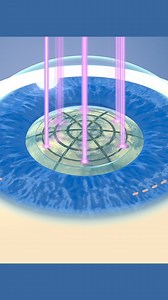 What are the benefits of laser cataract surgery? Here, we explain the process and when it may be necessary. | Duke Health | Facebook