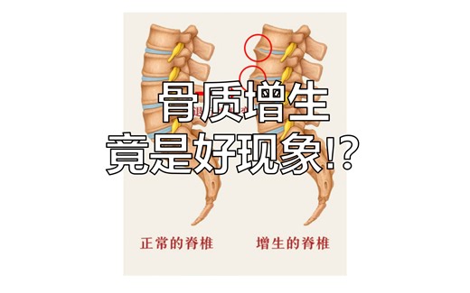 骨质增生的形成原因与处理思路