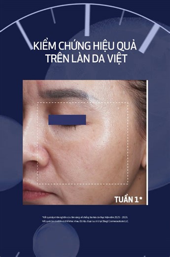 Công nghệ NAD⁺ đột phá giúp làn da trông trẻ hơn 1 tuổi chỉ sau 1 tuần, được kiểm chứng qua 3 nghiên cứu lâm sàng độc lập, 111 bệnh nhân tại Hoa Kỳ và Việt Nam. Nhờ công nghệ bào chế & dẫn truyền độc đáo, NU-GEN mang lại hiệu quả nhanh, thấy rõ trên da nhưng vẫn an toàn, phù hợp với mọi loại da Việt, kể cả da nhạy cảm hay da đang treatment. #ObagiMedicalVietnam #NUGEN #NAD #TreHoaTeBao #TreHoaDa
