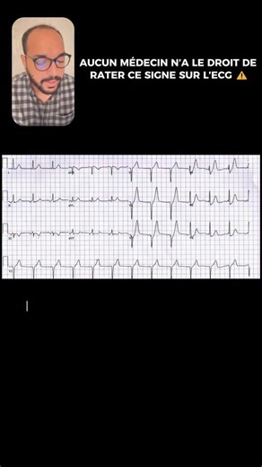 Ed-derbouti Omar on Instagram: "Commentez « STEMI » pour plus de vidéos comme celle-ci 🧠🔥 #urgence #ECG #cardiologie"