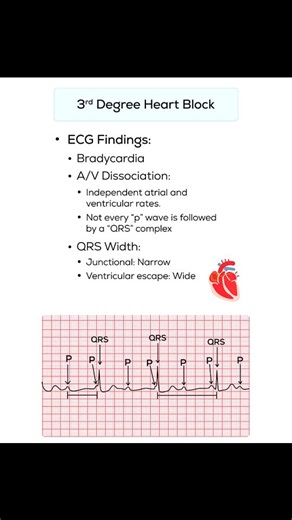 Third-degree AV block (complete heart block) shows no relationship between P waves and QRS complexes. Atria and ventricles beat independently. The ventricular escape rhythm is typically slow (20-40 BPM). This is a medical emergency requiring immediate pacing. #ECG #Cardiology #MedEd #HeartBlock | Abdallah Othman