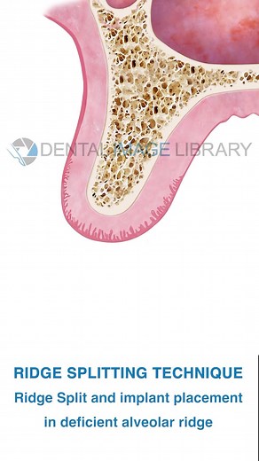 Ridge splitting technique for single dental implant placement at the maxilla. Collection of 6 single images: The dental implant cannot be placed due to the knife-edge alveolar bone morphology. A set of chisels of increasing width is used to split the alveolar ridge. The gap created by splitting is left empty. Transverse expansion allows for immediate dental implant installation. Sagittal section of the upper jaw. White background. Every single image is a jpeg file: 1654 x 2244 pixels 14 x 19 cm 