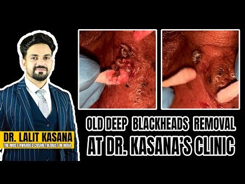 OLD DEEP BLACKHEADS REMOVAL AT DR.KASANA'S CLINIC