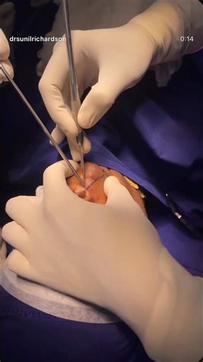 Major upper lip tumour resection and reconstruction plastic surgery