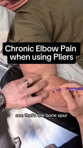 33-year-old skilled technician. 8 months of lateral elbow pain. Grip strength declining. Tools aggravating symptoms daily. On diagnostic ultrasound, we identified a lateral epicondyle bone spur irritating the common extensor tendon origin. We’ll be using the Tenex device to remove the spur under ultrasound guidance. These procedures require advanced musculoskeletal diagnostic and interventional ultrasound skill. Procedure video next. #ElbowPain #SportsMedicine #UltrasoundGuided #Tenex #LateralEp