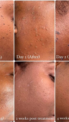 ✨ Check out these amazing DPN (mole removal) results in just 4 weeks! ✨ She trusted the process, and now her skin is glowing like never before! 💛 Here’s how it works: 1️⃣ Consultation: Your journey begins with a thorough consultation to assess your skin and customize the best treatment plan for you. 2️⃣ Cleansing: On treatment day, we’ll start by thoroughly cleansing the area to ensure it’s free from impurities and ready for the procedure. 3️⃣ Numbing: We apply a topical numbing cream to keep y