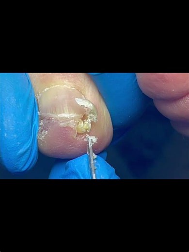 Quickly trim away the ingrown nail! #nails #pedicure