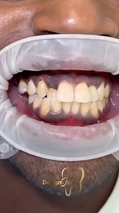 9K views · 13 reactions | Imagine a radiant smile, free from stains, fractures, or misalignments. ❤️With our porcelain design, you can enjoy perfectly sculpted and natural-looking teeth that reflect your unique personality. | Dental Design Smile | Facebook