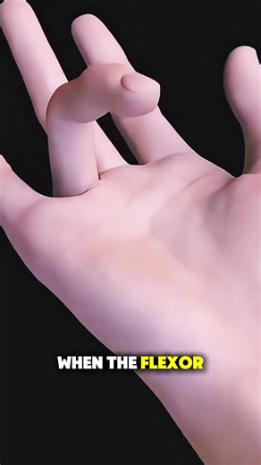 Trigger Finger Release Procedure 3d Animation #trigger #triggerfinger #triggerfingerrelease #medical3danimation