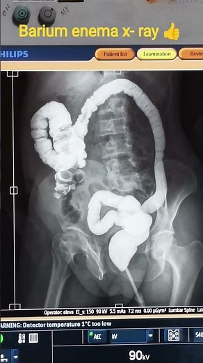 Barium enema of X-ray examination of the large intestine (colon and rectum) in #rims #baby #doctor