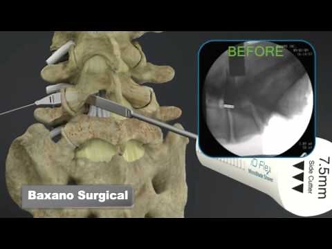 Sciatica Surgery, Dr. John Small - Florida Orthopaedic Institute