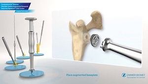 Comprehensive® Reverse Shoulder System Augmented Baseplate (Animation)