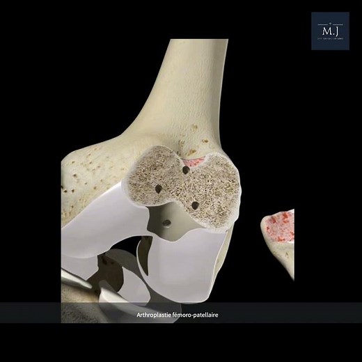 Patellofemoral Joint Replacement