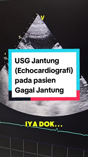 USG Jantung: Mendiagnosis Gagal Jantung Pasien