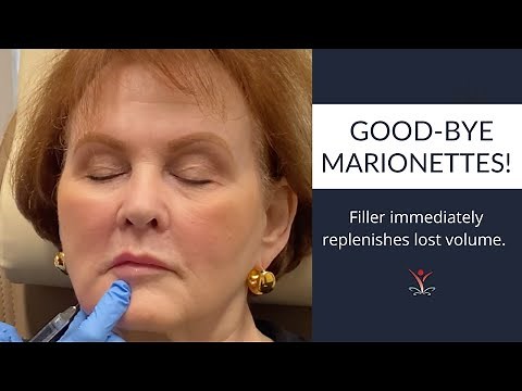 Do You Have Marionette Lines? Correct & Prevent them with Filler!