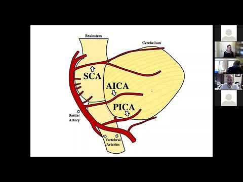 Management of Posterior Circulation Stroke Syndrome (Sept. 28, 2021)