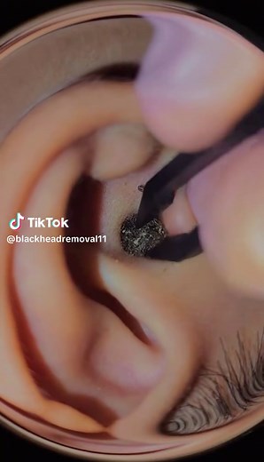 Unveiling the Black Mystery Stuck in Ear - Watch Now!
