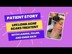 PATIENT STORY | LIFE LONG ACNE SCARS TREATENT WITH LASERS, FILLER, AND EMER SKIN