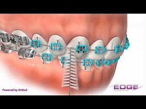 Proxy Brush - Blackburn Orthodontics