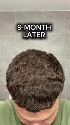 Frontal Area Hair Transplant | See the Result